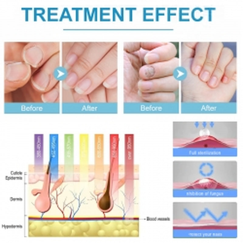 South Moon Nail Fungal Cleaning Laser Relief Device, Gray Nail Bad Nail Thickening Soft Nail Bright Nail Care Instrument